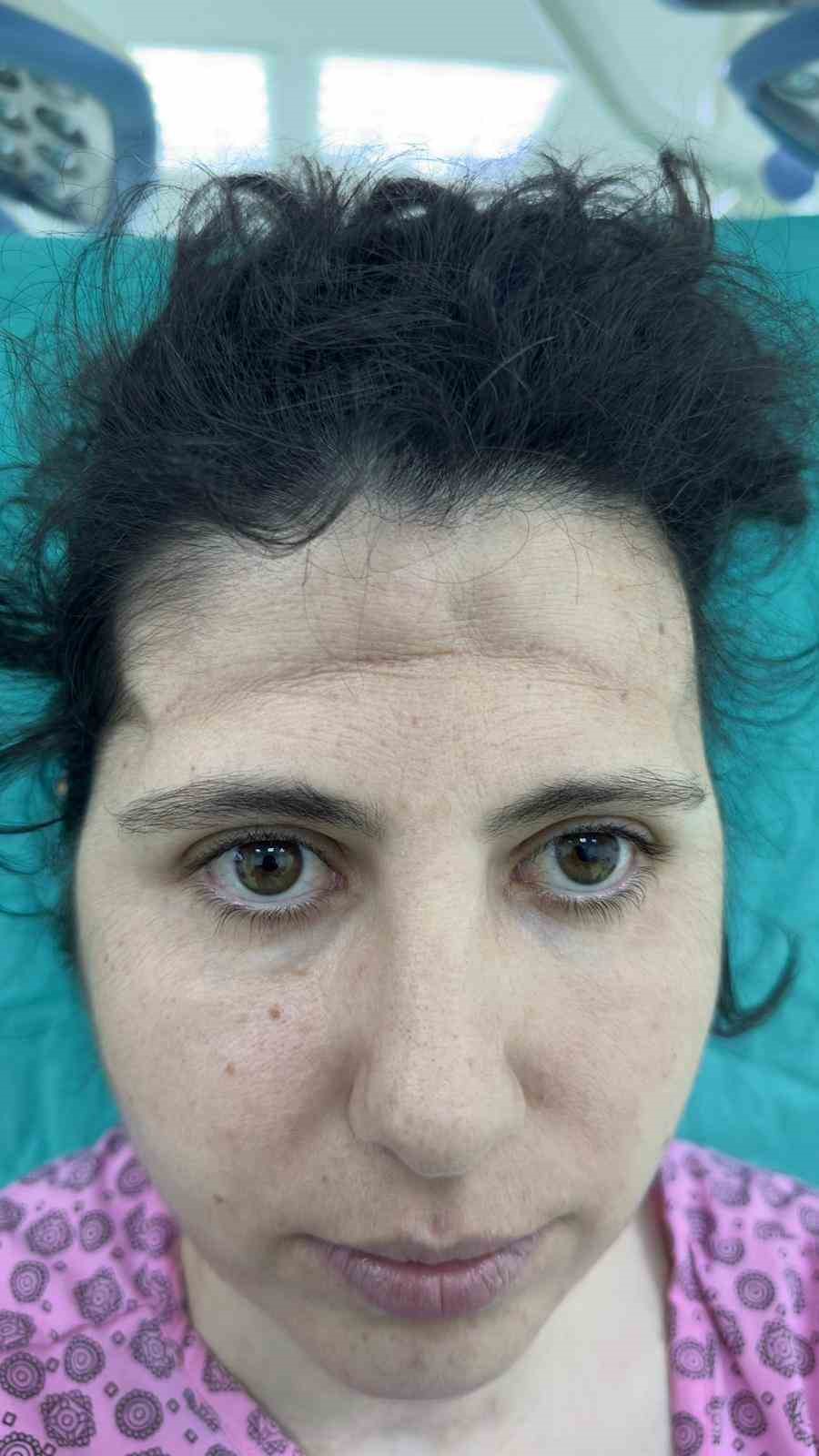 Beyin tümörü ameliyatı sonrası çöken alnı, 3 boyutlu implantla düzeltildi