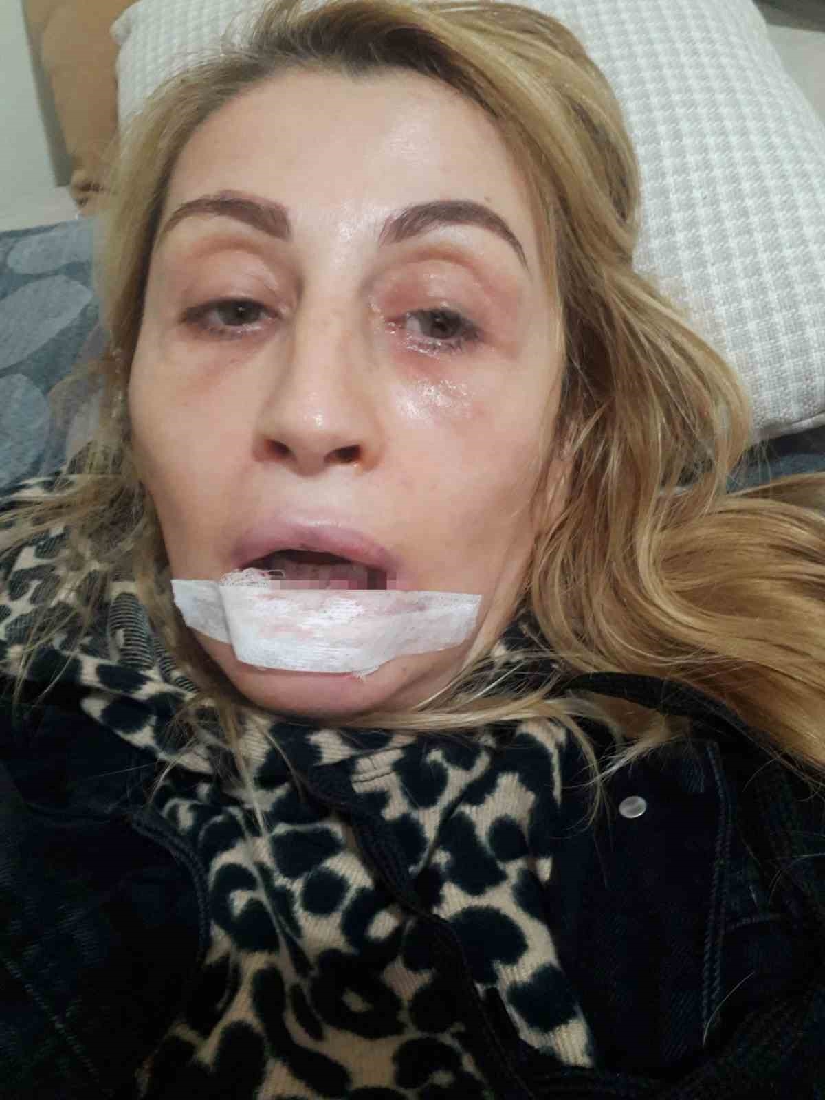 Estetik işlem sonrası dudağı çürüdü, 7 yıldır hukuk mücadelesi veriyor