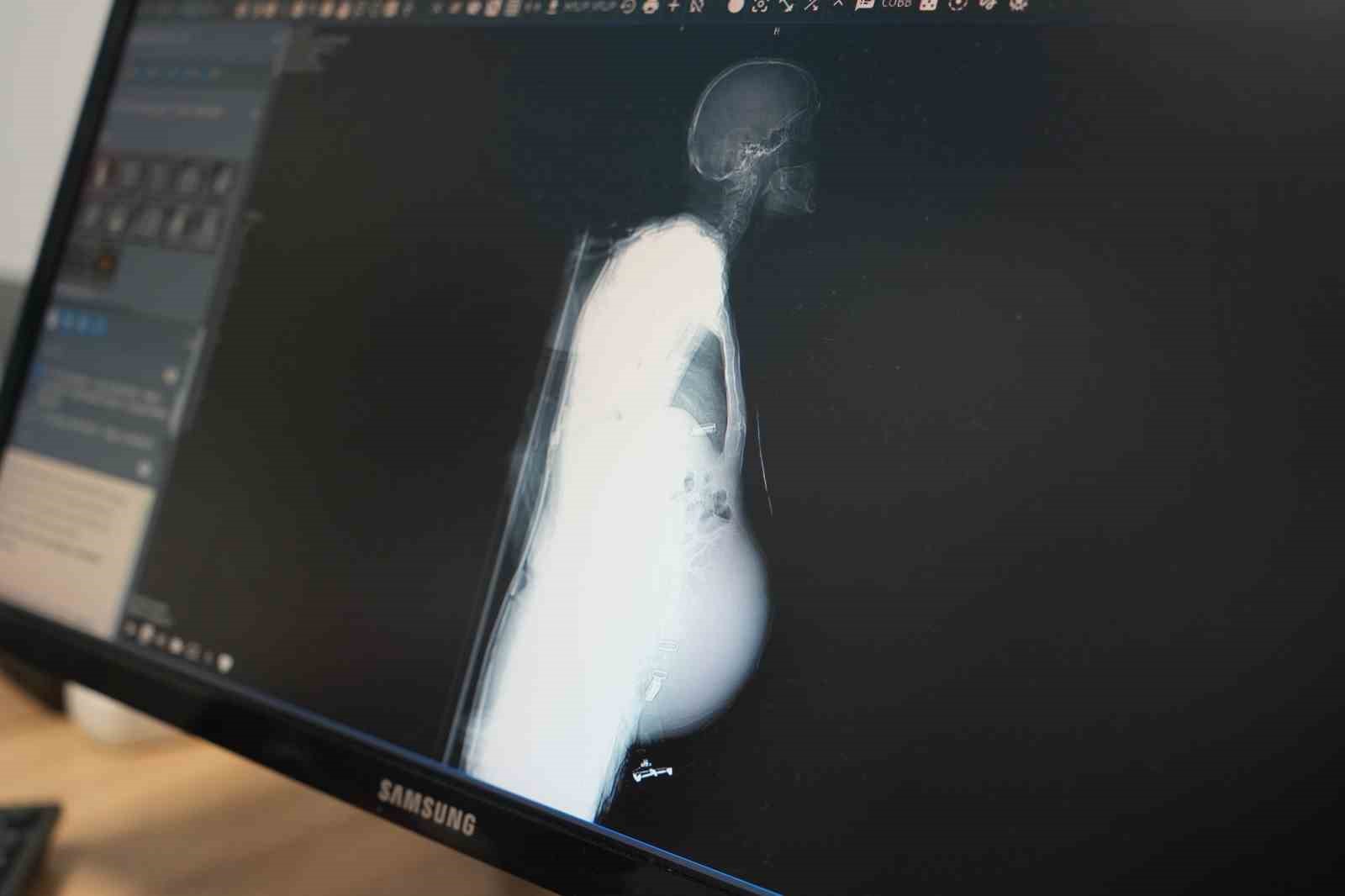 Doktorlar gözlerine inanamadı: 1,5 yıl ertelediği ameliyatta karnından dev kitle çıktı