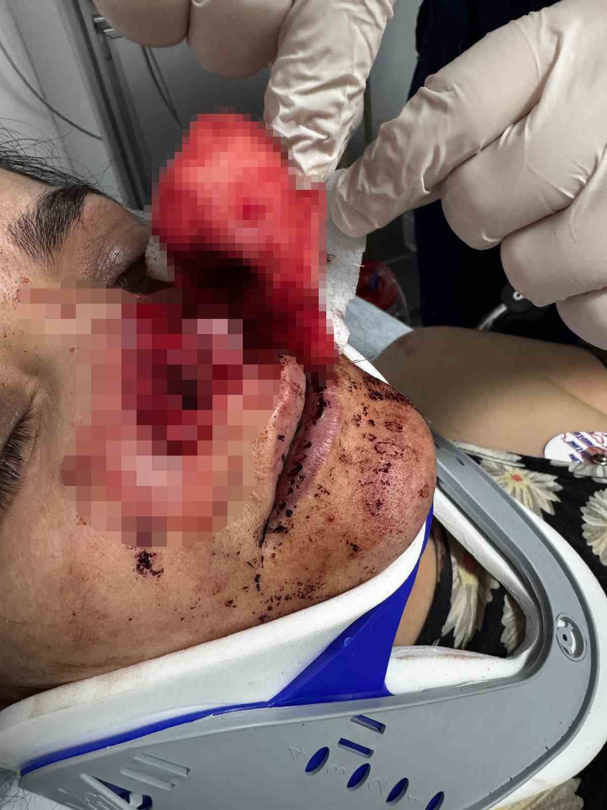 Eşinin kopardığı burnu başarılı operasyonla yerine dikildi